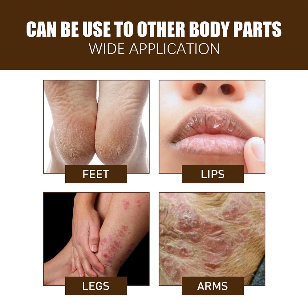 Krema za Ispucale Pete - SAMO KLIKNI