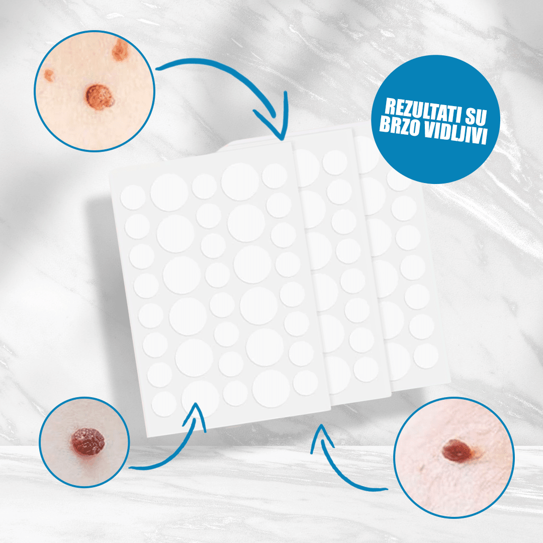 Flasteri za uklanjanje bradavica 3+1 GRATIS – – – slika 3